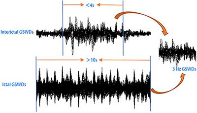 Differences Between Interictal and Ictal Generalized Spike-Wave Discharges in Childhood Absence Epilepsy: A MEG Study